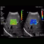 Elastografía de onda de corte y deformación - Philips EPIQ ELITE